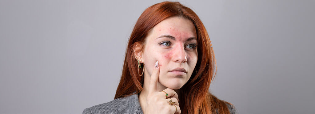 Stress Hives on Face