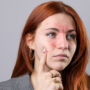 Stress Hives on Face: Causes, Symptoms, Treatment and More