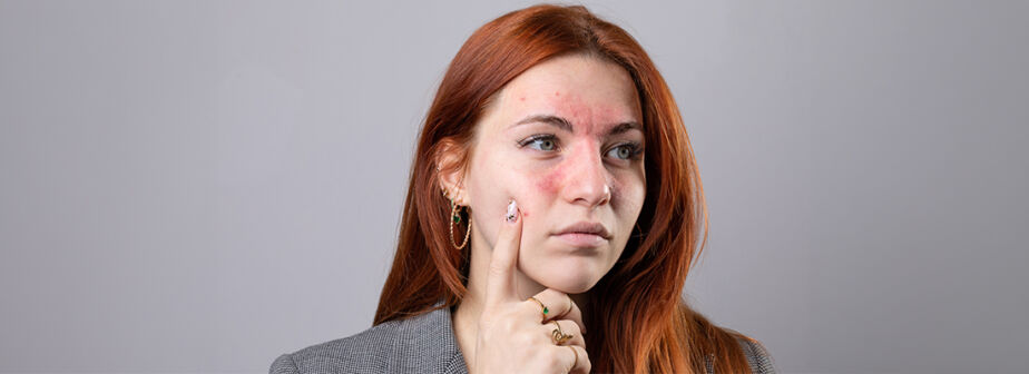 Stress Hives on Face