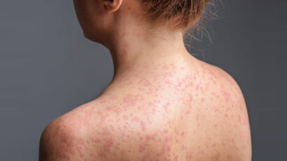 When to Worry About a Rash in Adults