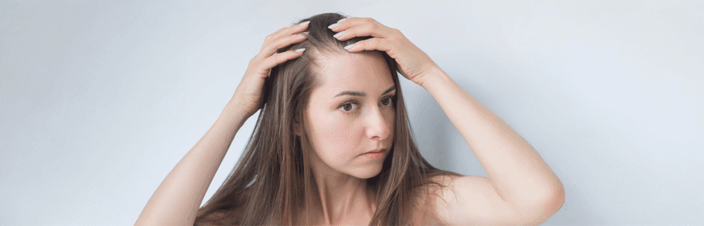 Alopecia Areata in Females