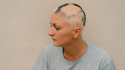 Types of Alopecia