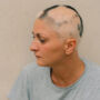 Types of Alopecia: Signs, Symptoms, Treatments and More