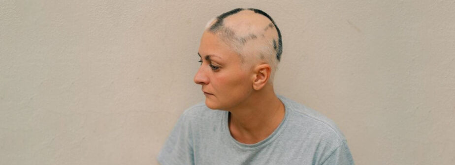 Types of Alopecia