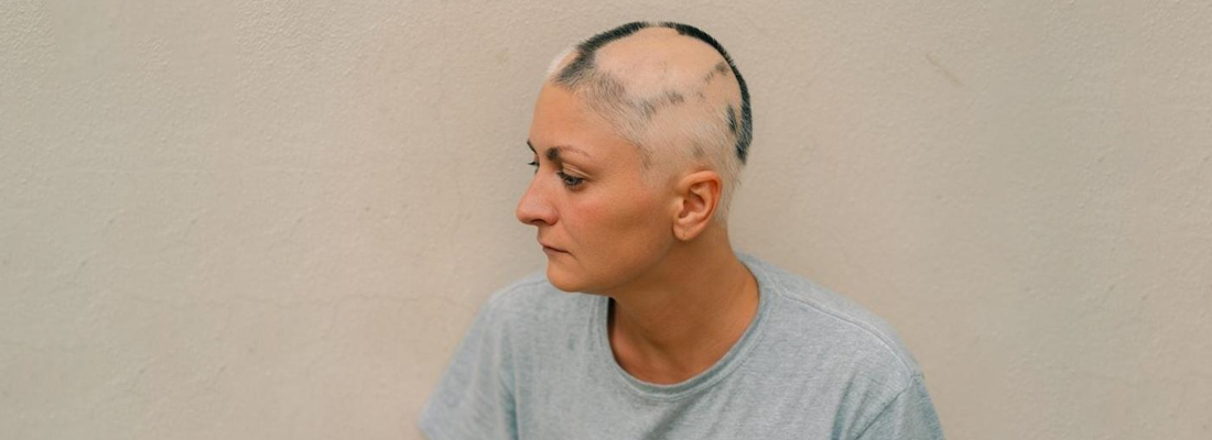Types of Alopecia