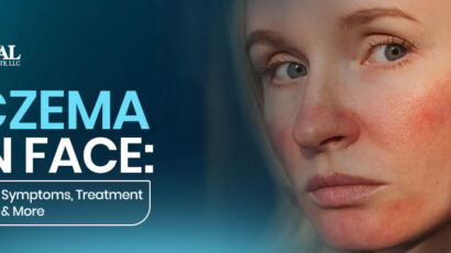 Eczema on Face