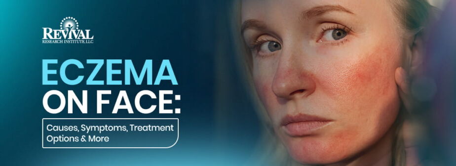 Eczema on Face