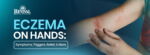Eczema on Hands: Symptoms, Triggers, Relief, and More