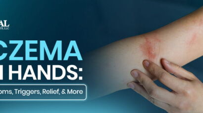 Eczema on Hands