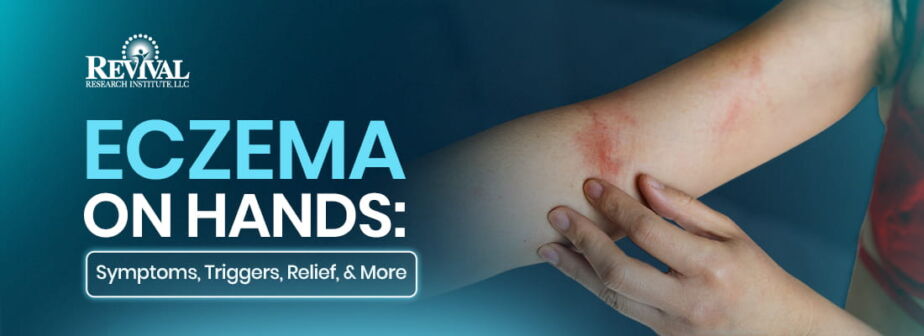 Eczema on Hands