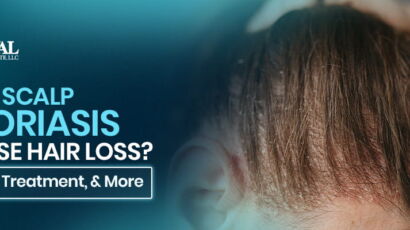 Can Psoriasis Cause Hair Loss