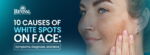 10 Causes of White Spots on Face: Symptoms, Diagnosis, and More