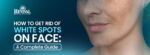 How to Get Rid of White Spots on Face: A Complete Guide